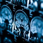 Brain + xray